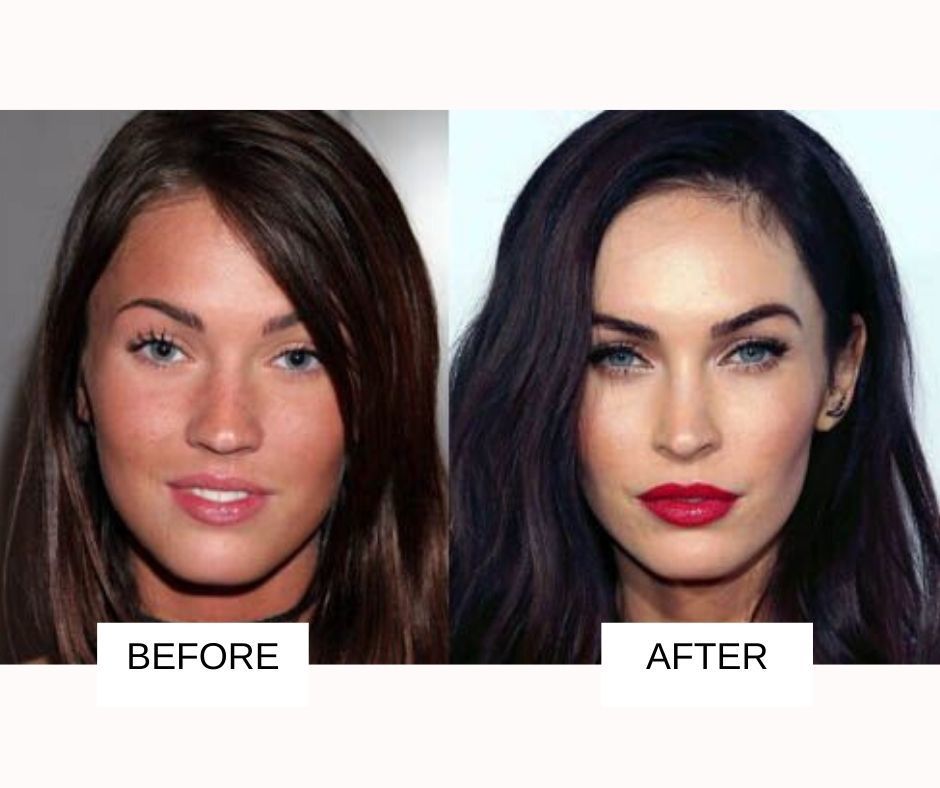 Plastic Surgery Before And After Nose Gone Wrong Plastic Surgery Before And After Nose Gone Wrong