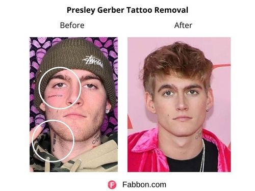25 Celebritities Who Removed Their Tattoos Fabbon